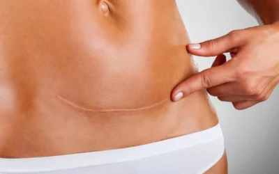 Scar Tissue and Adhesion Treatment